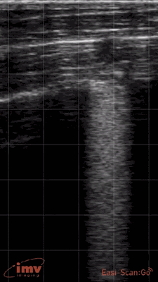 Lung Consolidation in dairy calf